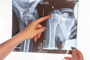 Common Types of Injuries Caused by Car Accidents - Minnesota Injury - Mcewen Kestner PLLC Personal Injury Attorneys - Broken Bones